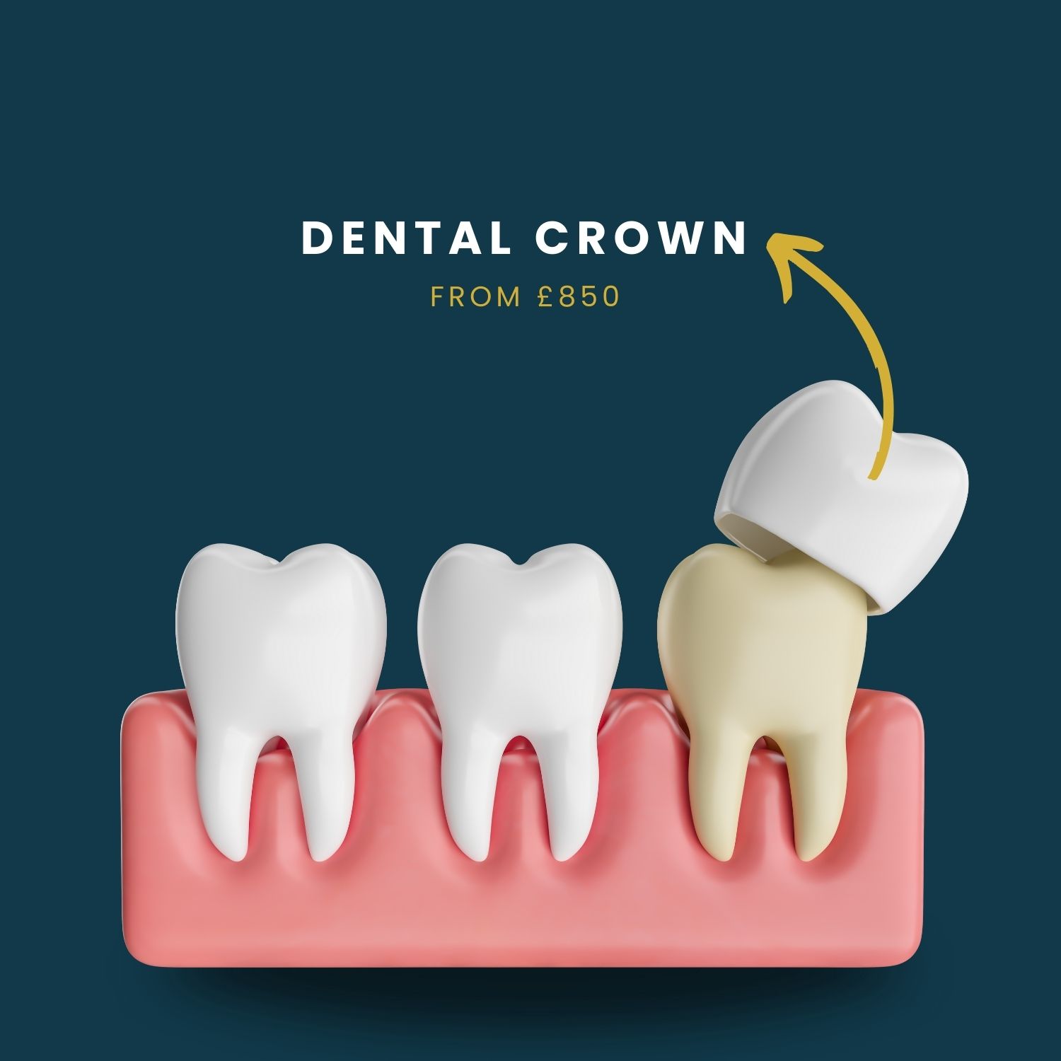 Dental crown cost image